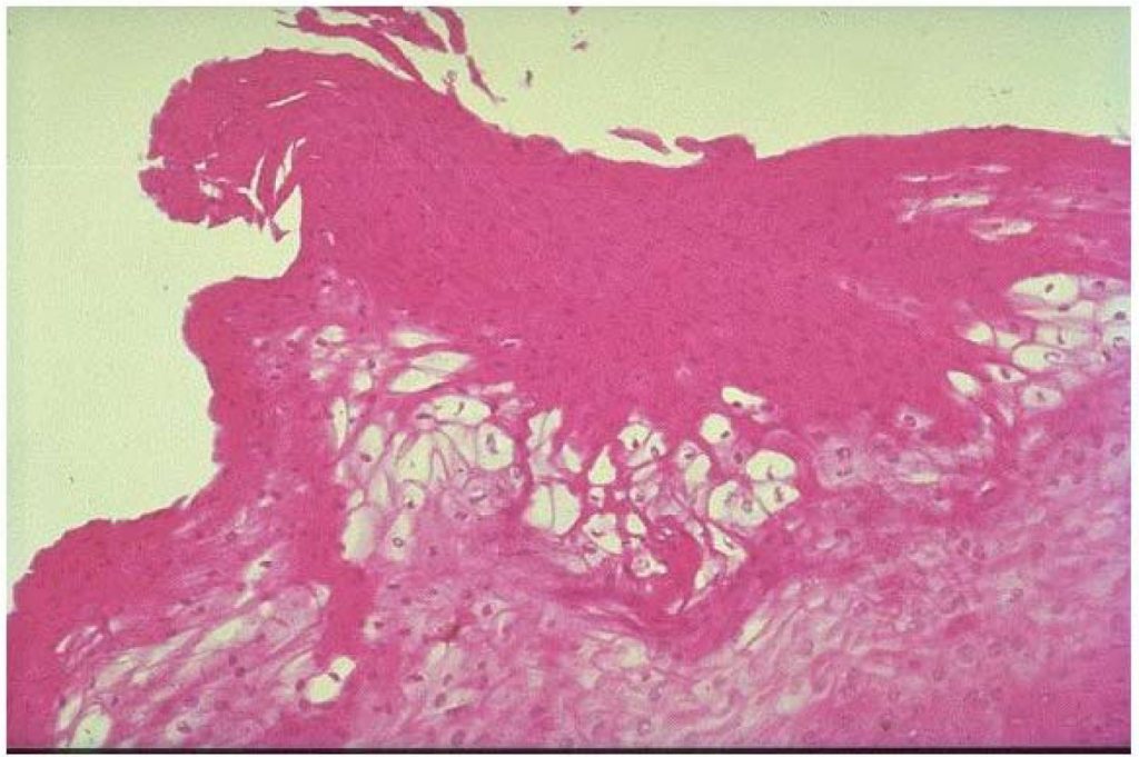 Hairy Leukoplakia European Association Of Oral Medicine