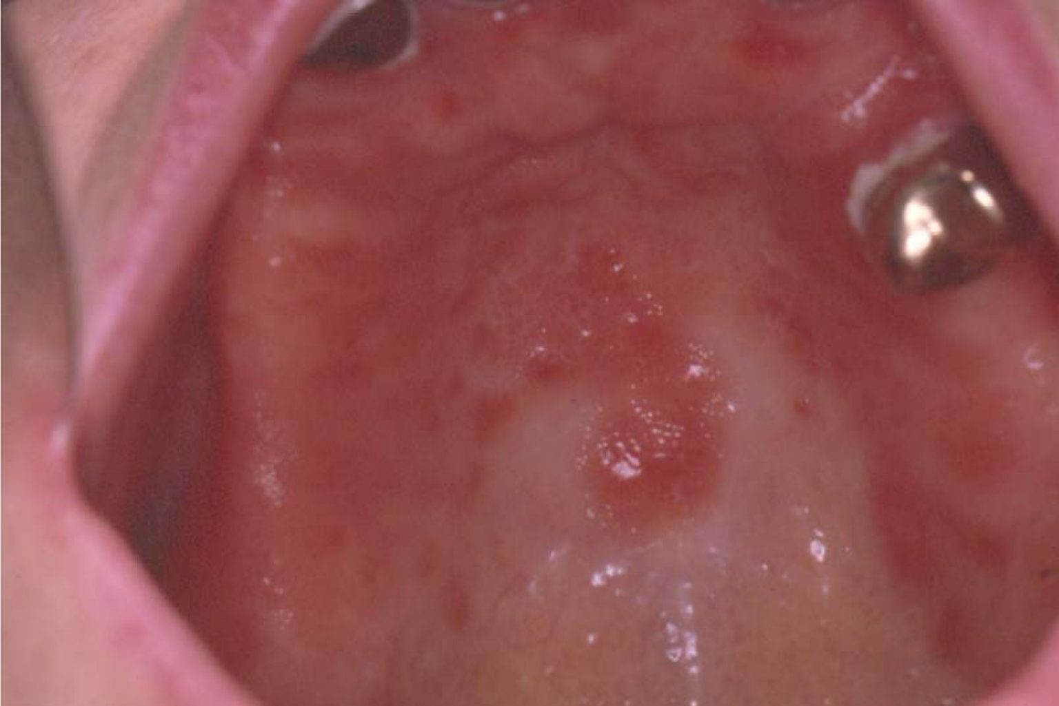 Denture Related Stomatitis European Association of Oral Medicine