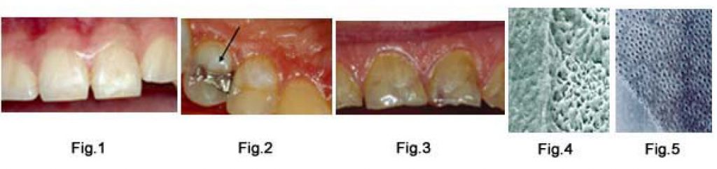 Tooth Erosion – European Association of Oral Medicine