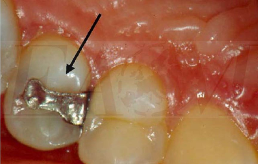 Tooth Erosion European Association of Oral Medicine