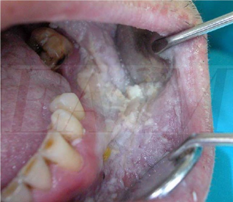 White Sponge Nevus European Association of Oral Medicine