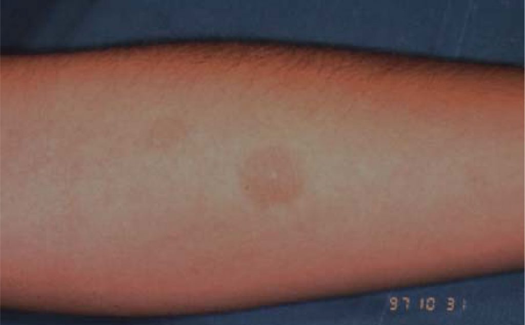 Erythema Multiforme – European Association of Oral Medicine