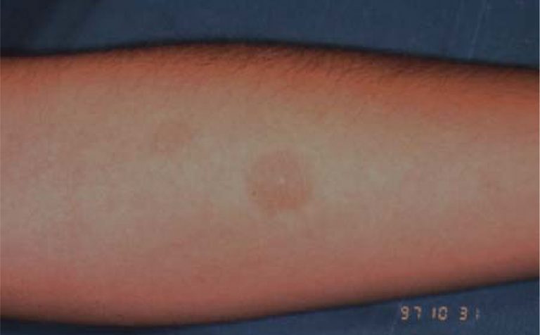 Erythema Multiforme – European Association of Oral Medicine