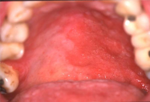 Graft Versus Host Disease – European Association of Oral Medicine