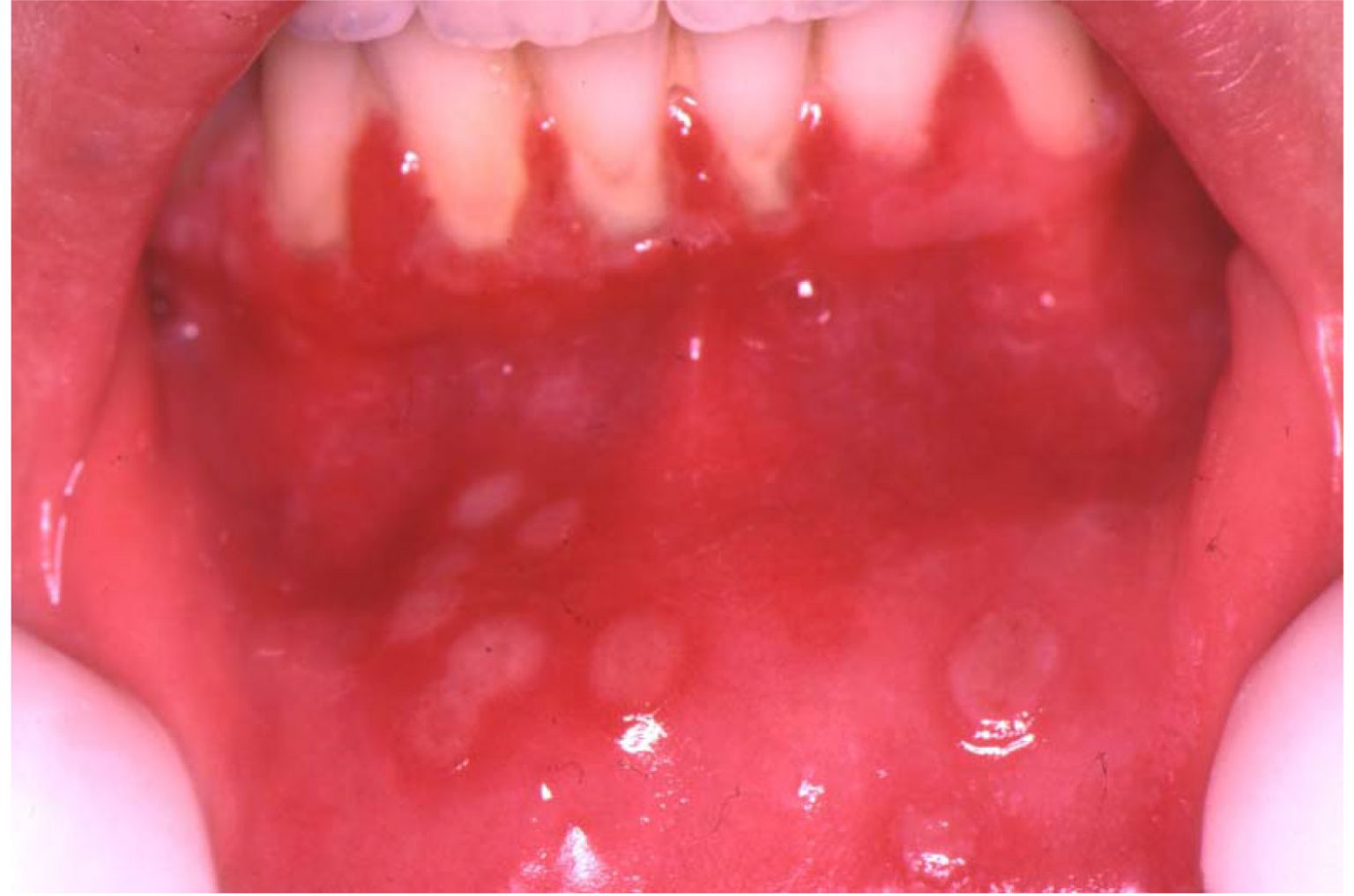 Herpes Simplex Virus (Hsv) Infection Of The Mouth – European ...