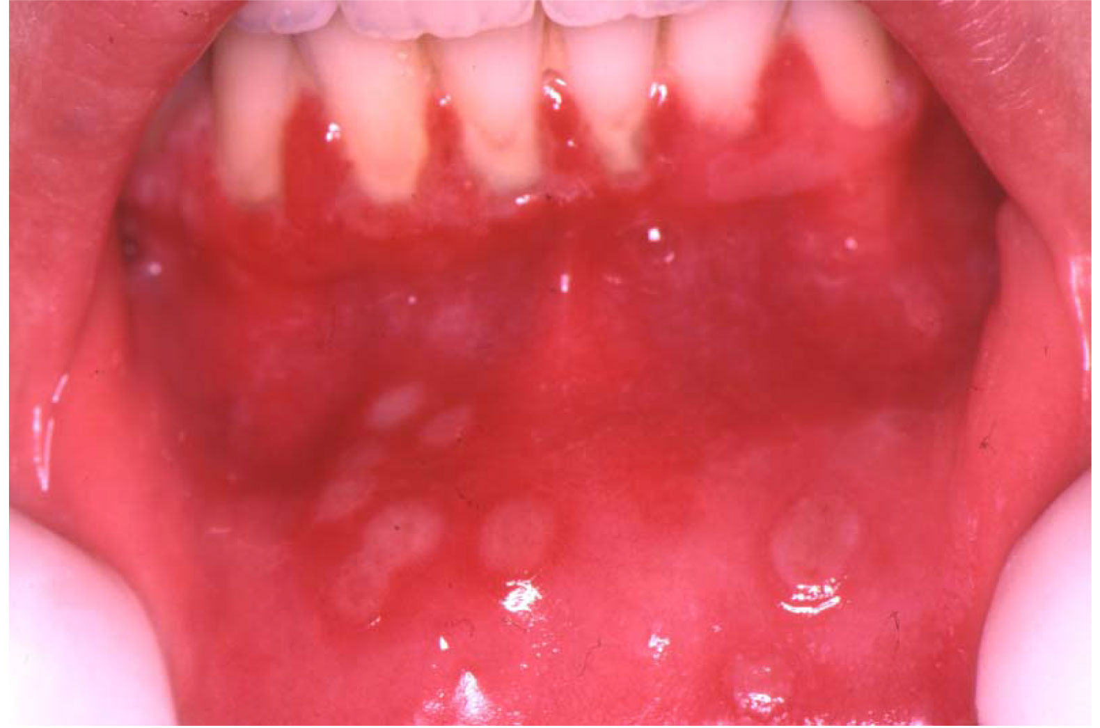 clinical presentation of oral herpes
