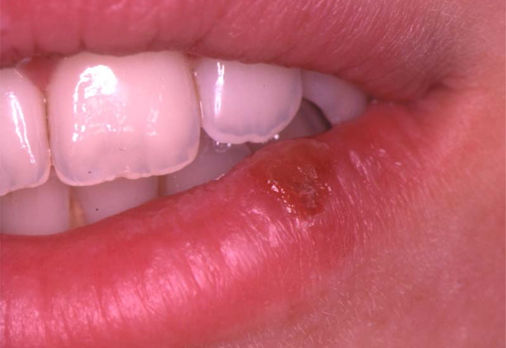 Herpes Simplex Virus Hsv Infection Of The Mouth European 