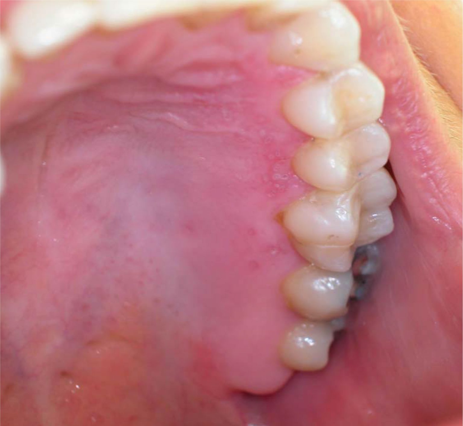 Herpes Simplex Virus (Hsv) Infection Of The Mouth European