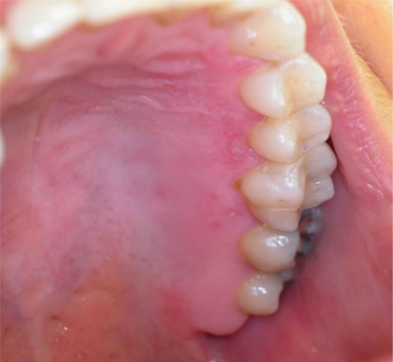 Herpes Simplex Virus Hsv Infection Of The Mouth European Association Of Oral Medicine