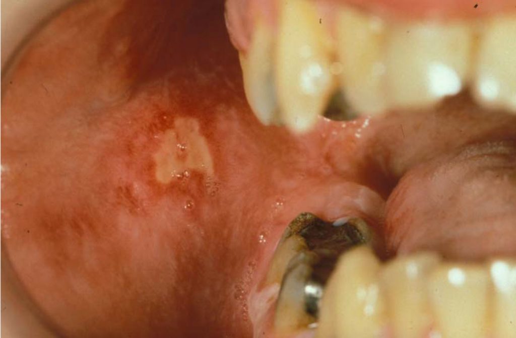 clinical presentation of oral mucositis