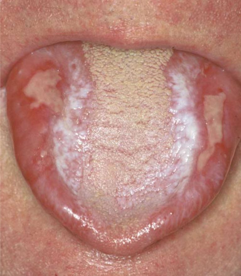 Oral Lichen Planus Cancer Hot Sex Picture