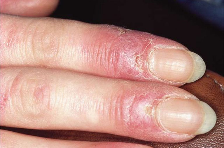 Oral Lupus Erythematosus European Association of Oral Medicine