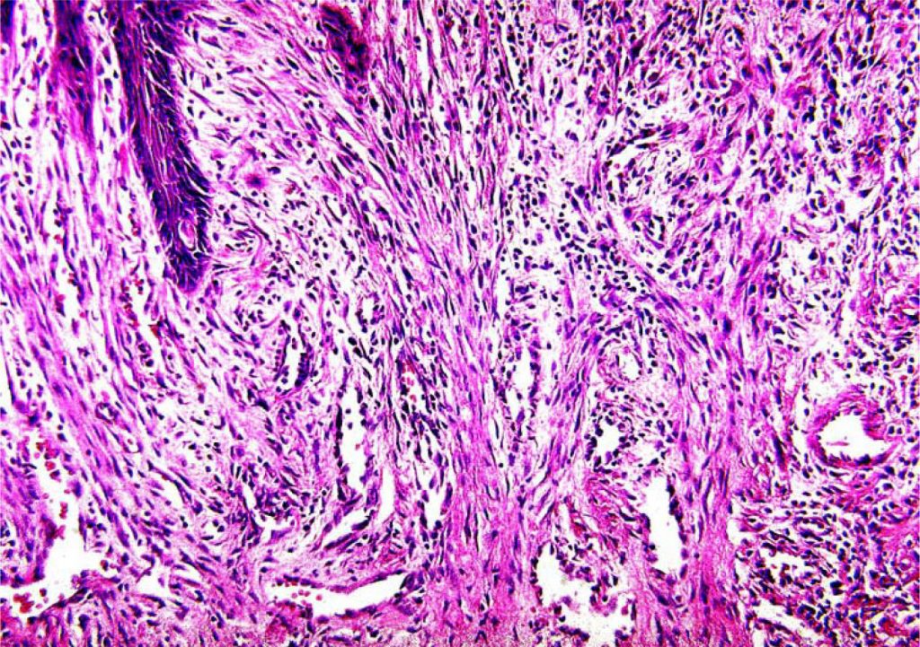 Pyogenic Granuloma European Association Of Oral Medicine