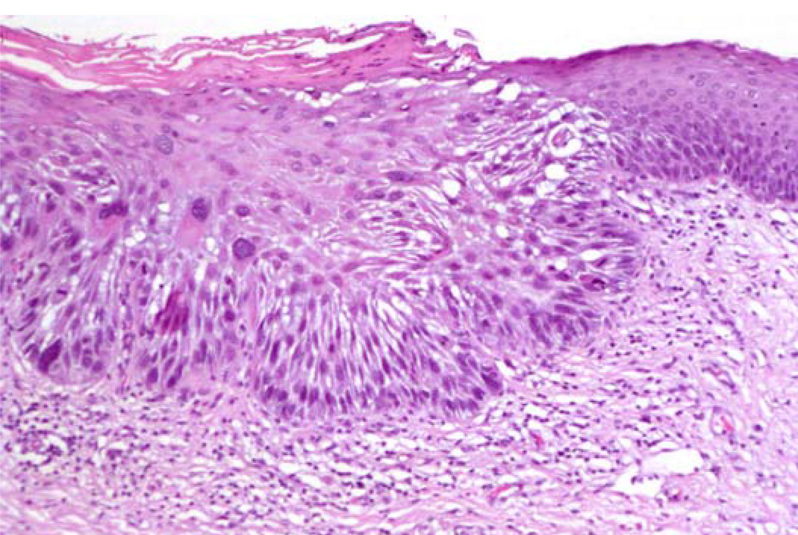 Tobacco, Effects On Oral Health European Association of Oral Medicine